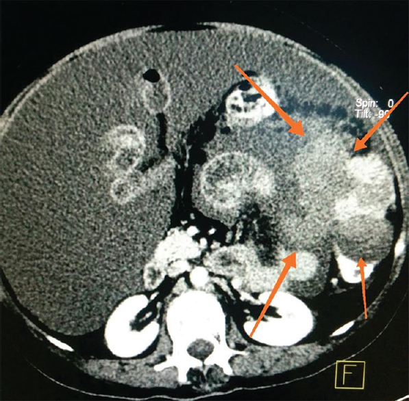 Contrast-enhanced computed tomography axial section of the abdomen showing a heterogeneous enhancing soft-tissue lesion (arrows) in the left lumbar region along the serosal surface of the left colon with necrotic areas within it.